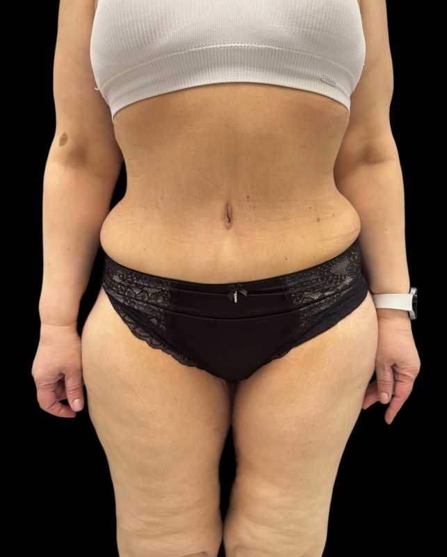 bodylift