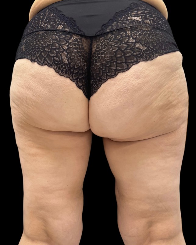 bodylift