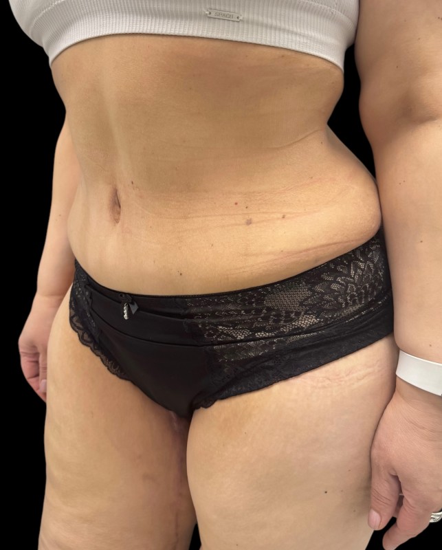 bodylift