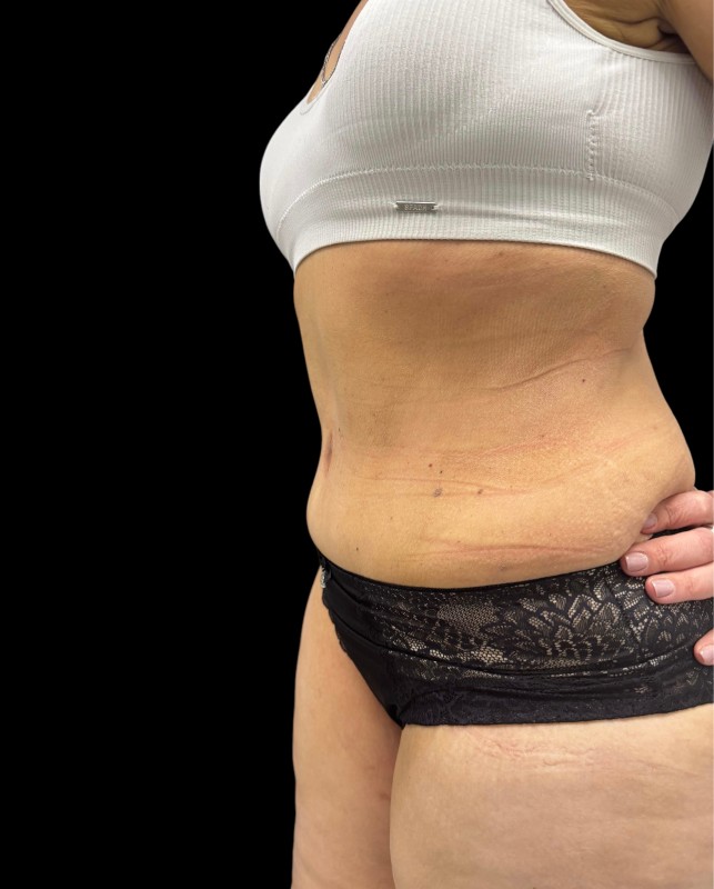 bodylift