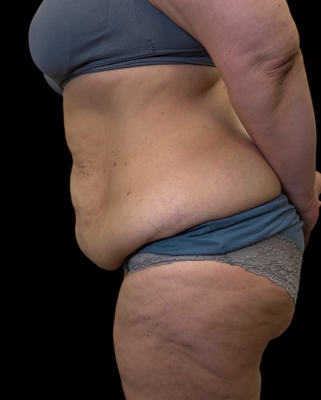 bodylift