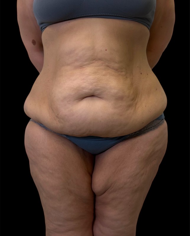 bodylift