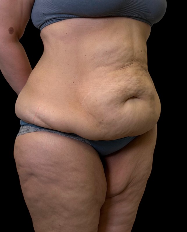 bodylift