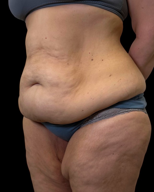 bodylift