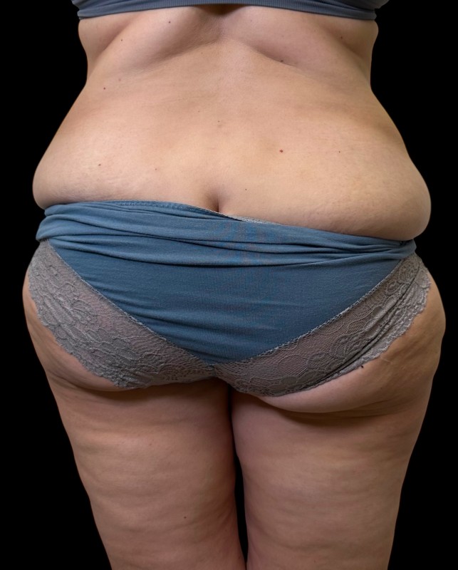 bodylift