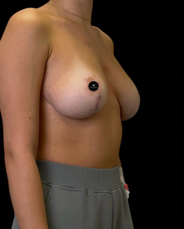 Mammoplasty