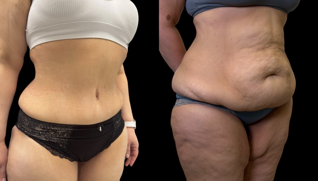 before after