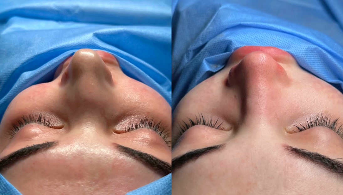 before after
