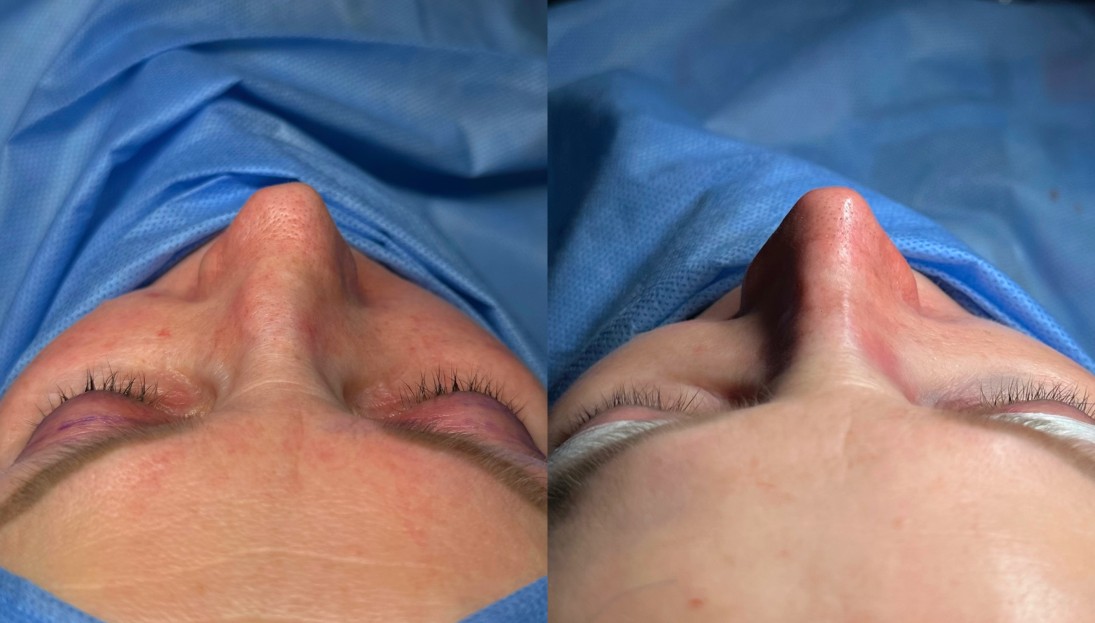 before after