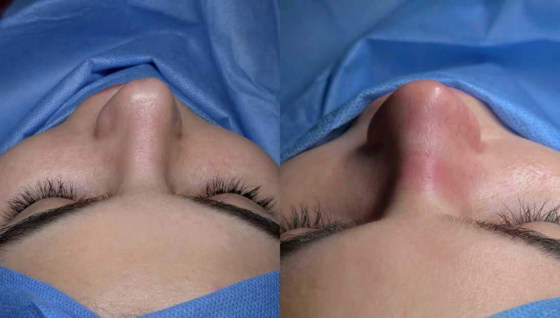 before after