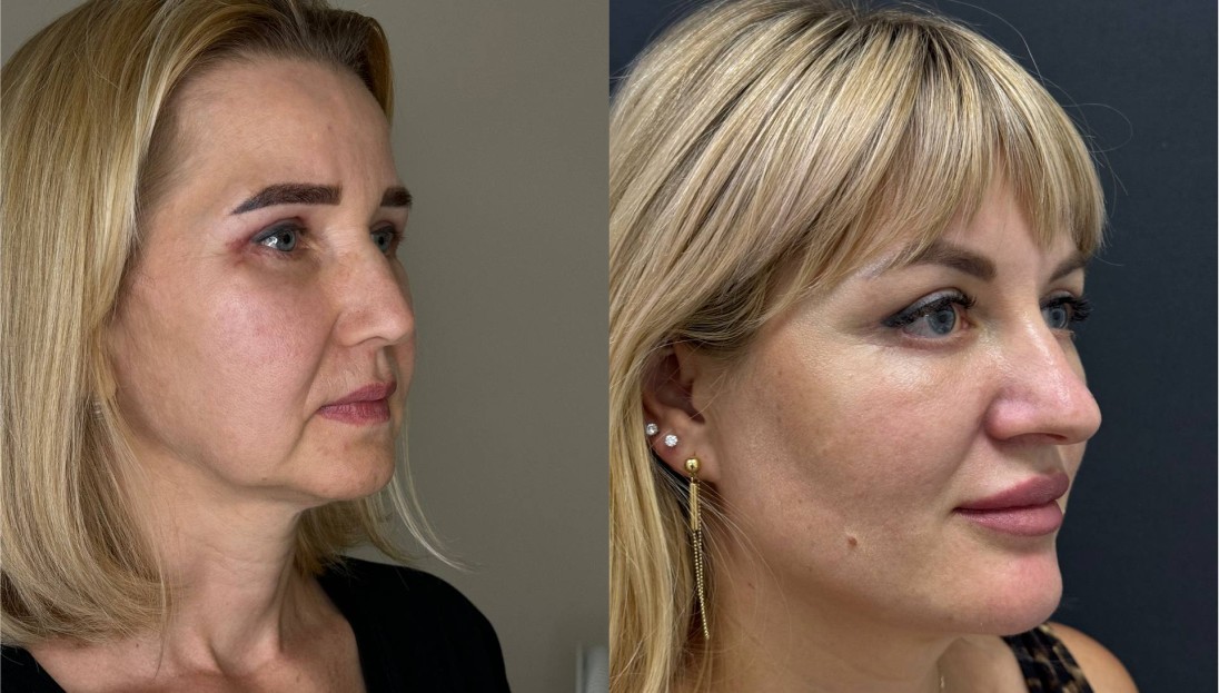 before after