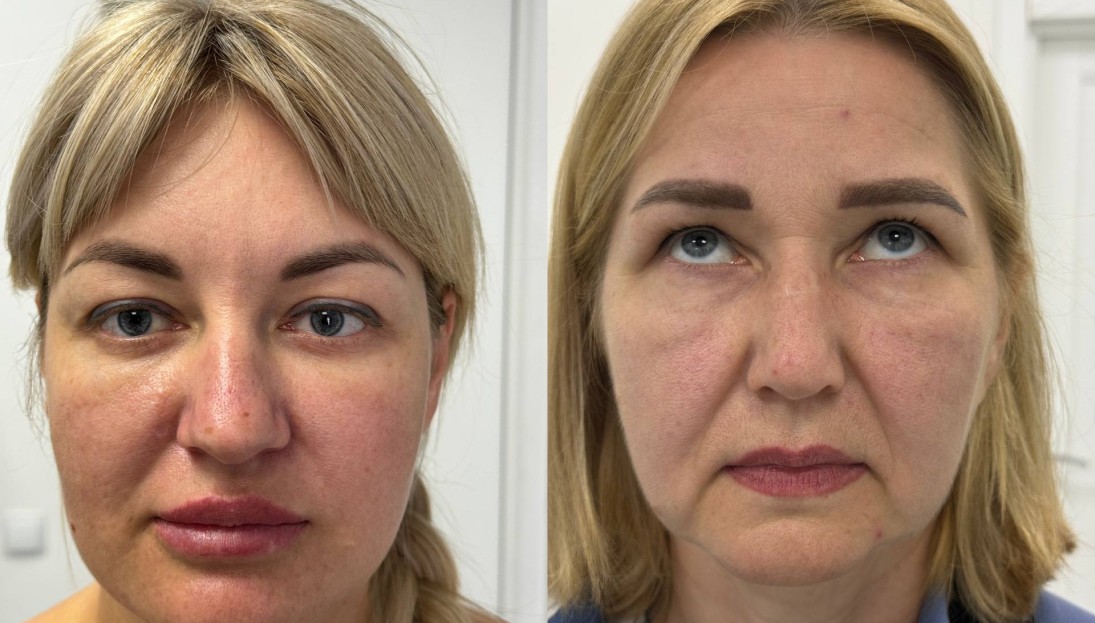 before after