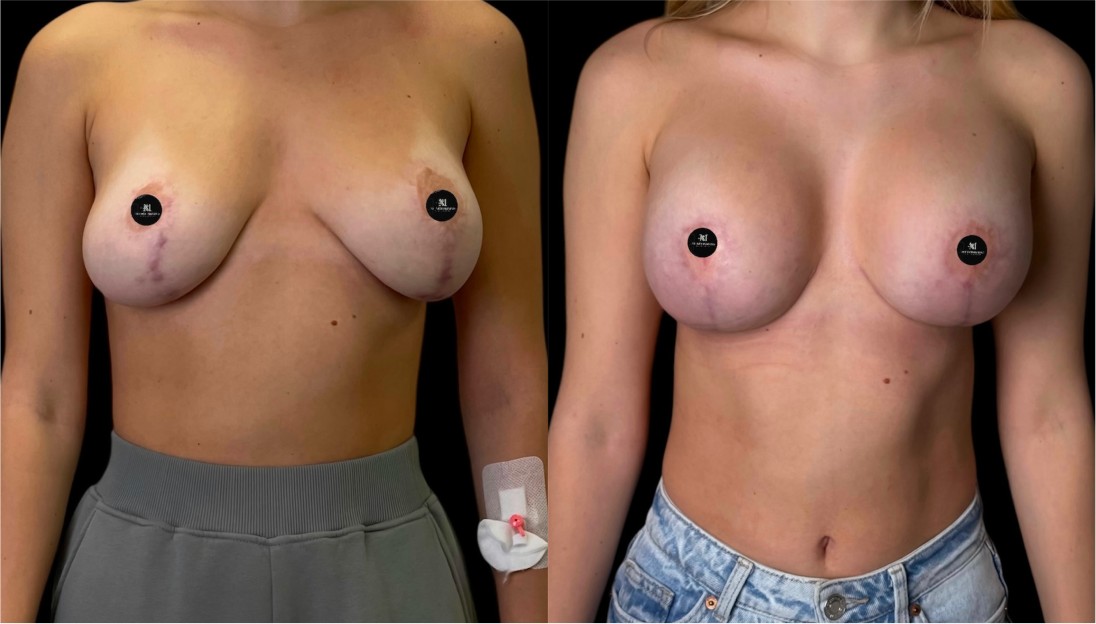before after