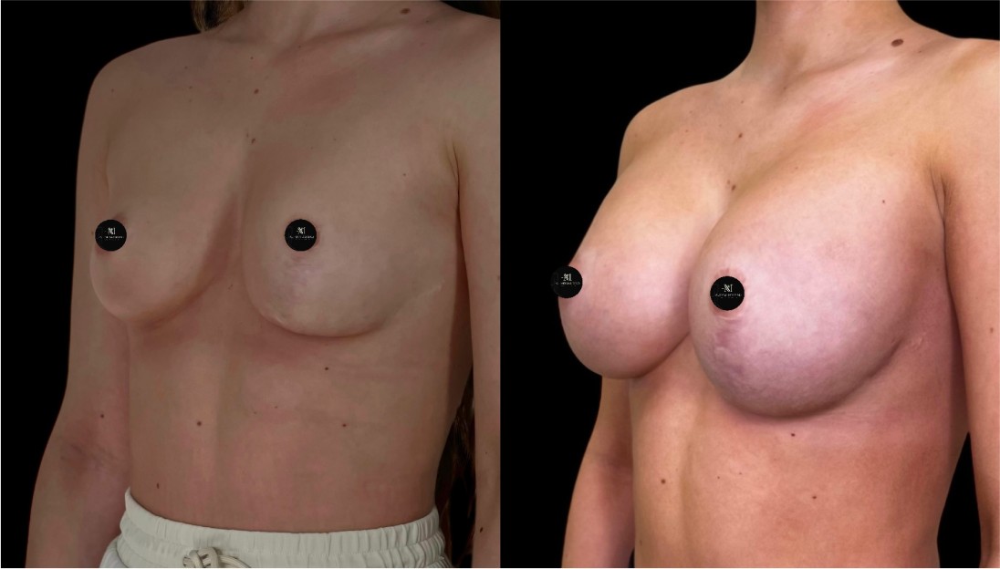 before after