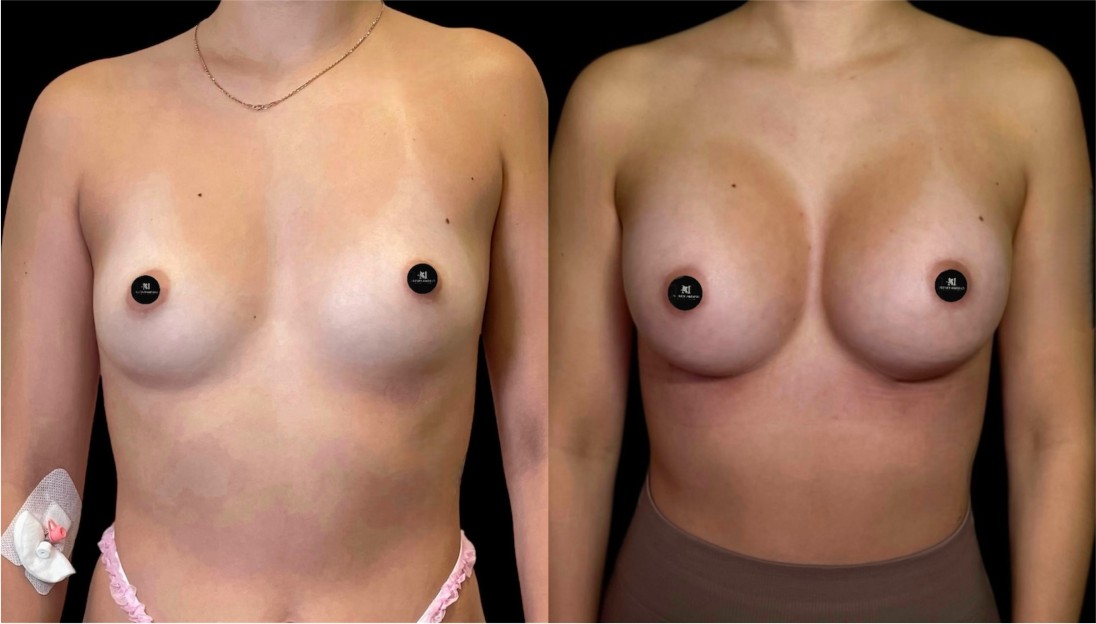 before after