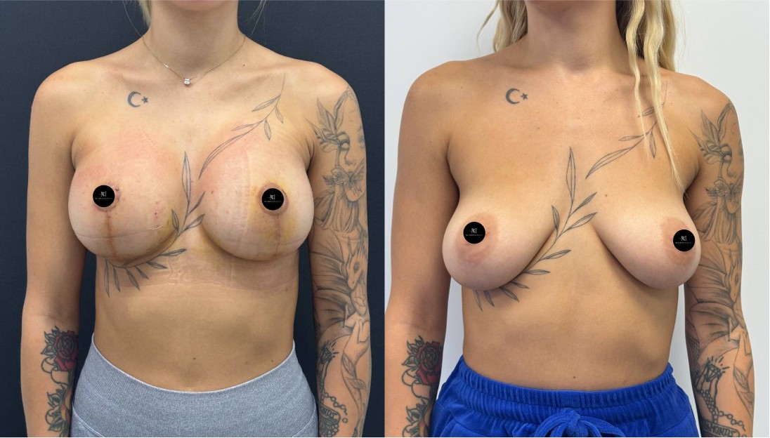 before after